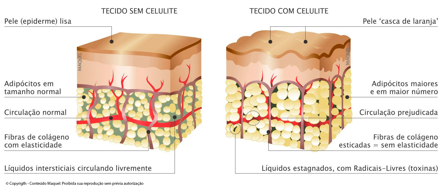 Revelado segredo milenar para eliminar celulite